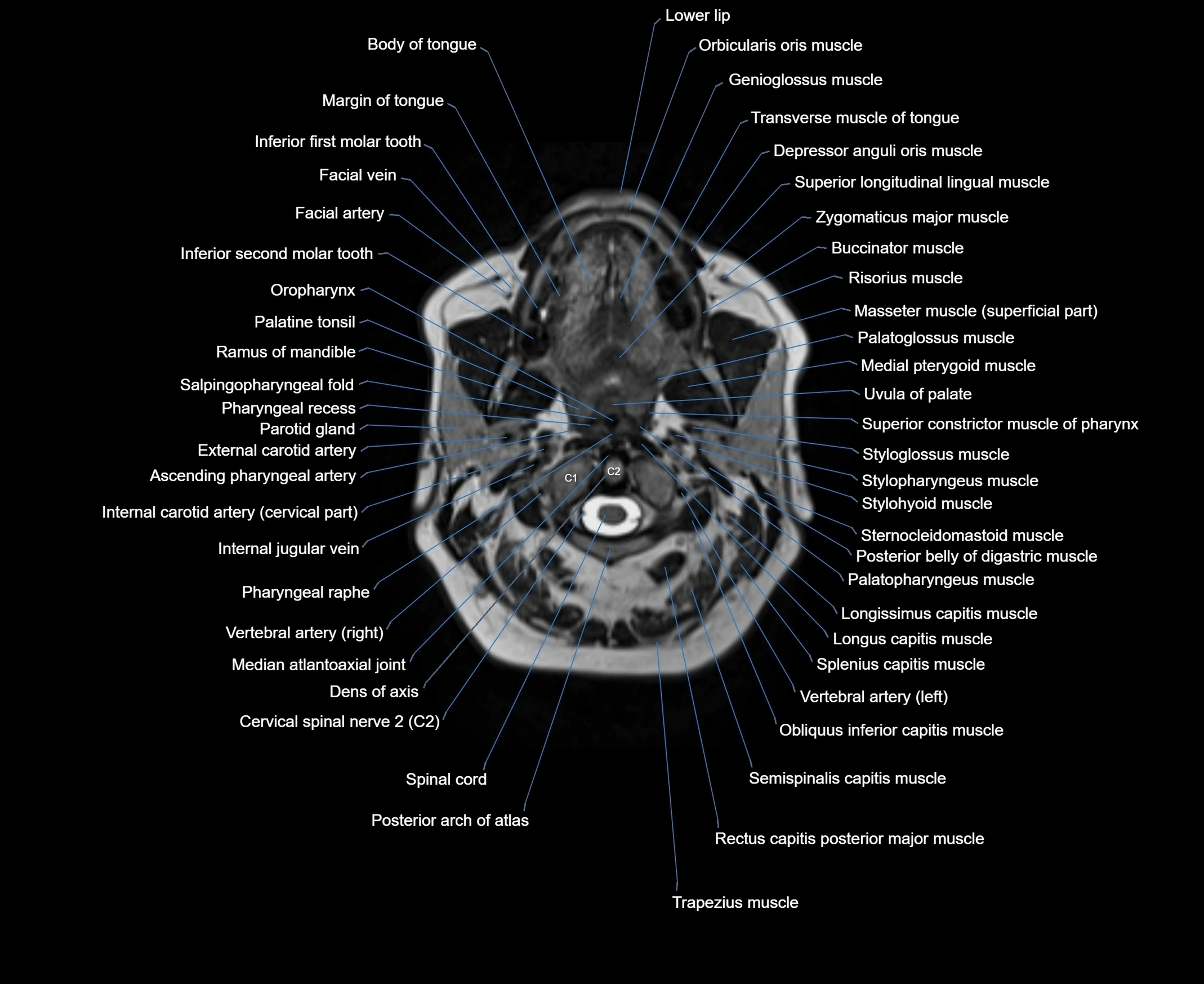 MRI Neck 3D labelled cross section anatomy axial 3t image-00001-00028.webp